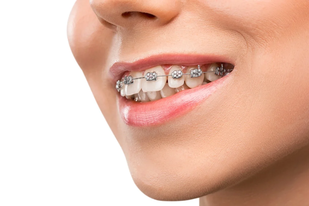Orthodontic dental braces treatment at National Medical Center Satwa Dubai