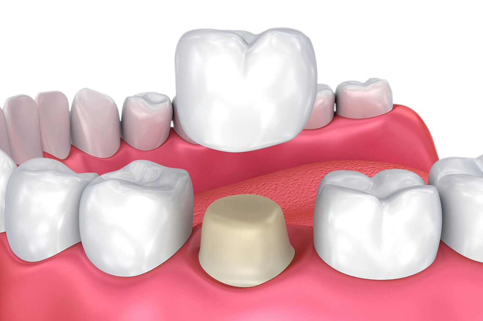 Porcelain and zirconia dental crowns at National Medical Center Dubai