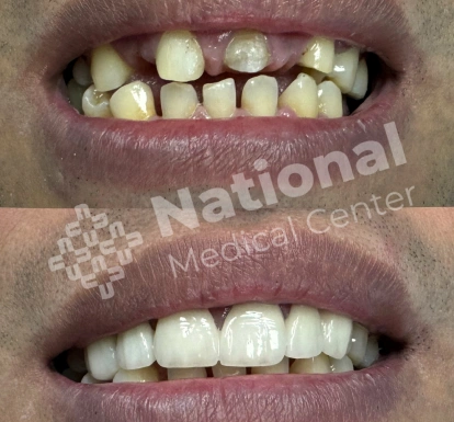 Fixed porcelain dental bridge replacing missing premolar tooth