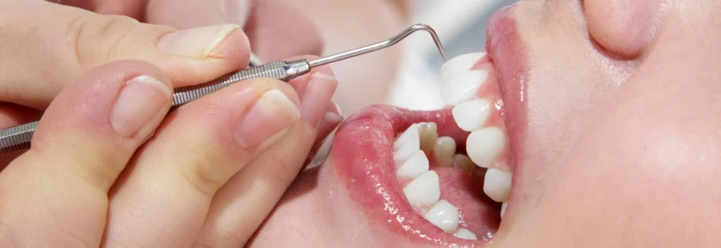 Professional teeth cleaning and scaling at National Medical Center Satwa Dubai