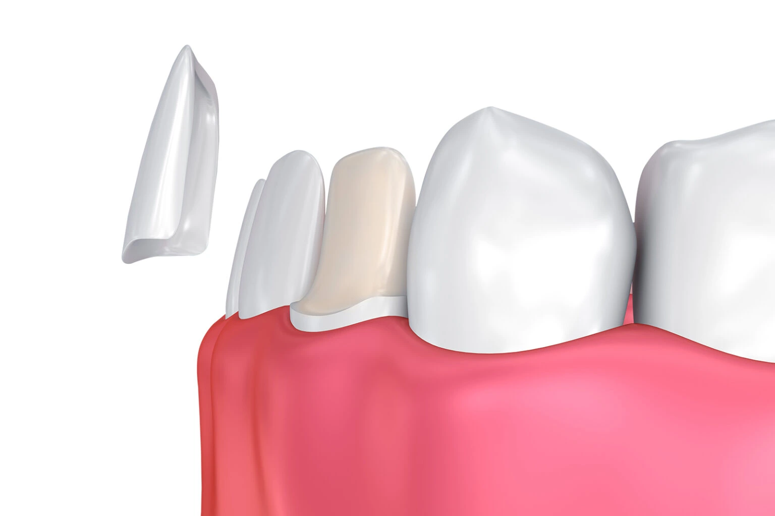 Cosmetic porcelain dental veneers and Hollywood Smile at National Medical Center